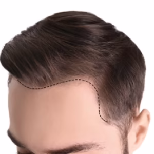 hair transplant docter near me. aura hair transplant clinic is best hair transplant clinic in ahmedabad.