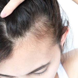 Woman serious hair loss problem for health care shampoo and beauty product concept